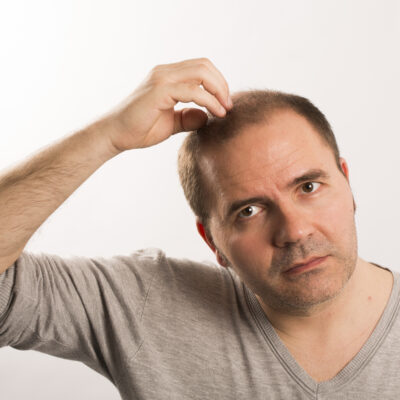 Proven Tips to Treat Male Pattern Baldness